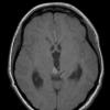 9A2 Papillary Tumor Pineal Region (Case 9) T1noC axial A - Copy