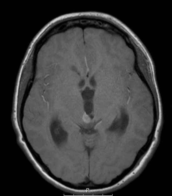 9A2 Papillary Tumor Pineal Region (Case 9) T1noC axial A - Copy