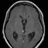 9A3 Papillary Tumor Pineal Region (Case 9) T1W A - Copy