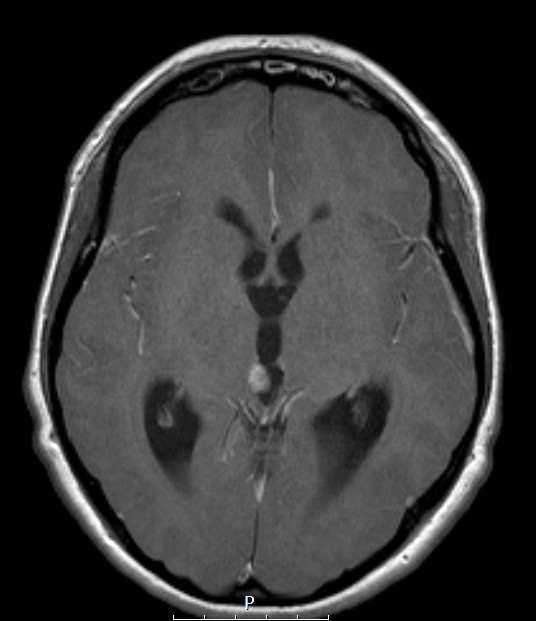 9A3 Papillary Tumor Pineal Region (Case 9) T1W A - Copy