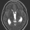 9A4 Papillary Tumor Pineal Region (Case 9) T2noC axial A - Copy