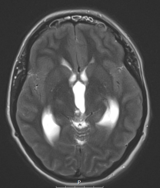 9A4 Papillary Tumor Pineal Region (Case 9) T2noC axial A - Copy