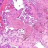 9B1 Papillary Tumor Pineal Region (Case 9) H&E 2 (2).jpg