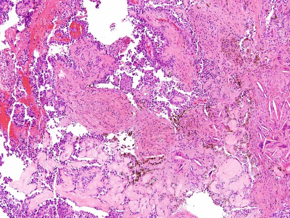 9B1 Papillary Tumor Pineal Region (Case 9) H&E 2 (2).jpg