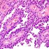 9B2 Papillary Tumor Pineal Region (Case 9) H&E 1 (2).jpg