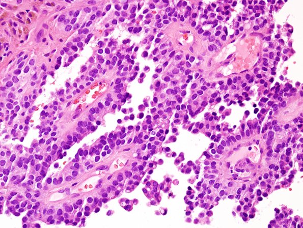 9B2 Papillary Tumor Pineal Region (Case 9) H&E 1 (2).jpg