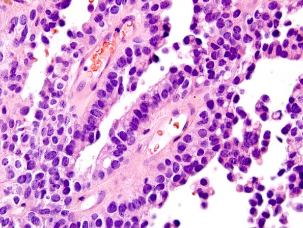 9B3 Papillary Tumor Pineal Region (Case 9) H&E 20