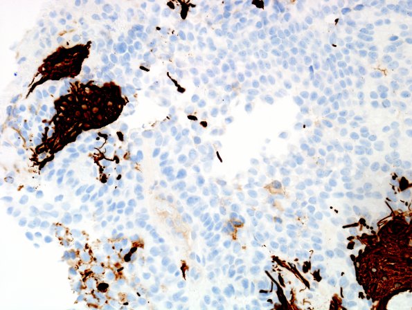 9F Papillary Tumor Pineal Region (Case 9) GFAP 5 (2).jpg