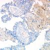 9G Papillary Tumor Pineal Region (Case 9) SYN 2.jpg