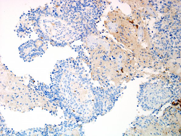 9G Papillary Tumor Pineal Region (Case 9) SYN 2.jpg