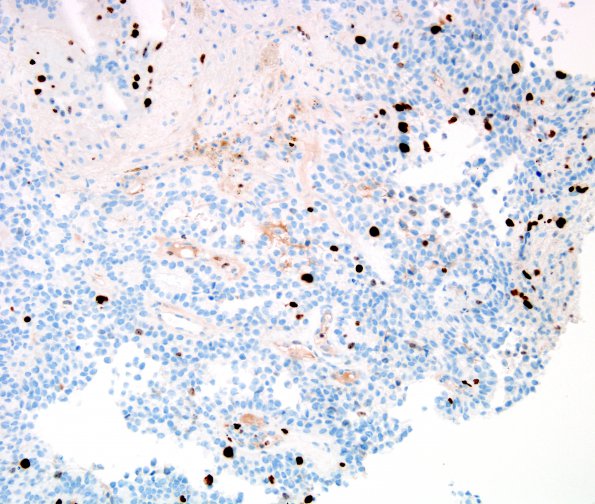 9I Papillary Tumor Pineal Region (Case 9) MIB 2