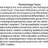 Pineal Anlage Tumor