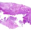 1A Pineal Anlage Tumor (Case 1) 1 H&E whole mount