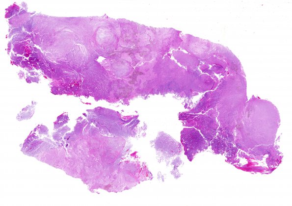 1A Pineal Anlage Tumor (Case 1) 1 H&E whole mount