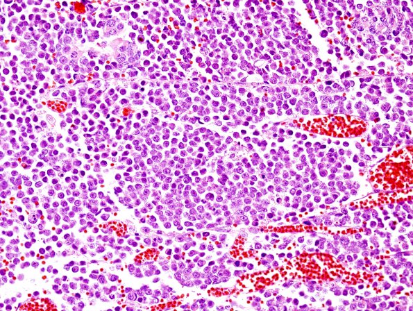 1B1 Pineal Anlage Tumor (Case 1) area A H&E 4.jpg