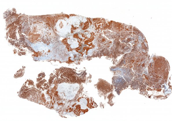 1B4 Pineal Anlage Tumor (Case 1) 1 SYN whole mount