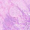 1C1 Pineal Anlage Tumor (Case 1) H&E 18