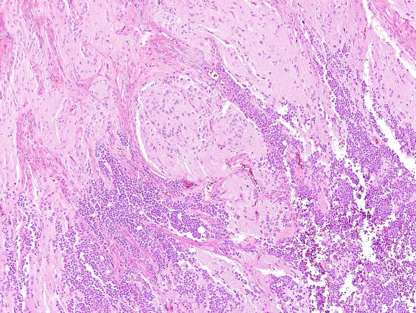 1C1 Pineal Anlage Tumor (Case 1) H&E 18