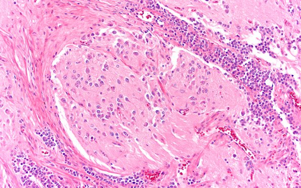 1C2 Pineal Anlage Tumor (Case 1) H&E 20x A