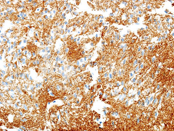 1C3 Pineal Anlage Tumor (Case 1) area A SYN 1.jpg