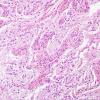 1C6 Pineal Anlage Tumor (Case 1) H&E 14