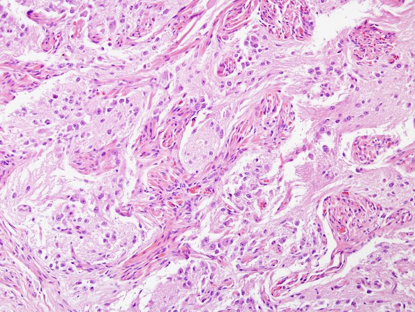 1C6 Pineal Anlage Tumor (Case 1) H&E 14