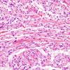 1D1 Pineal Anlage Tumor (Case 1) area A H&E 5.jpg