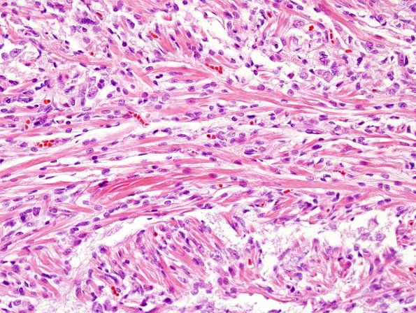 1D1 Pineal Anlage Tumor (Case 1) area A H&E 5.jpg