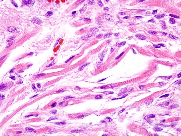 1D2 Pineal Anlage Tumor (Case 1) H&E 4