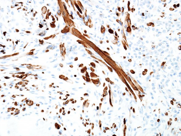 1D5 Pineal Anlage Tumor (Case 1) Desmin