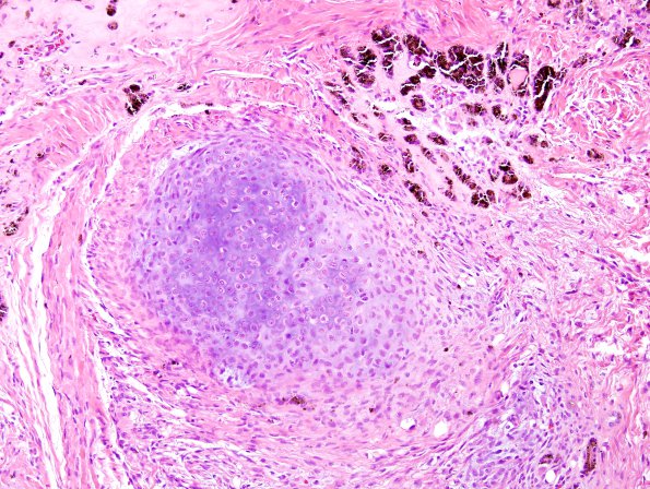 1E Pineal Anlage Tumor (Case 1) H&E 2