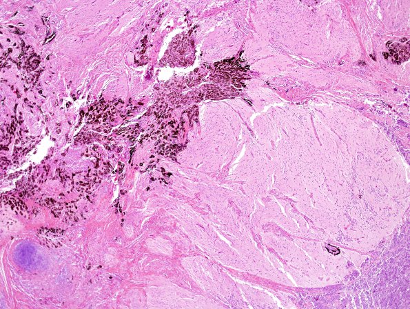 1F1 Pineal Anlage Tumor (Case 1) H&E 16