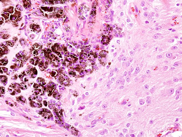 1F2 Pineal Anlage Tumor (Case 1) H&E 15