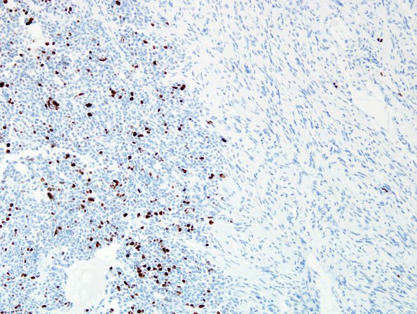 1G1 Pineal Anlage Tumor (Case 1) area A Ki67 2.jpg