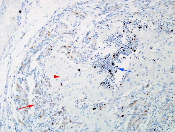 1G3 Pineal Anlage Tumor (Case 1) MIB 2 copy copy