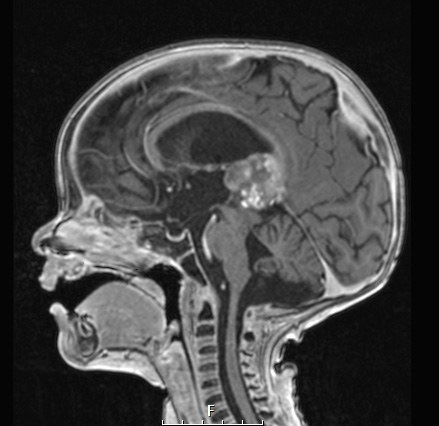 2A Pineal Anlage Tumor (Case 2) T1W 2 B - Copy