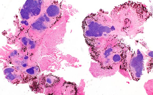 2B1 Pineal Anlage Tumor (Case 2) B5 H&E 2X