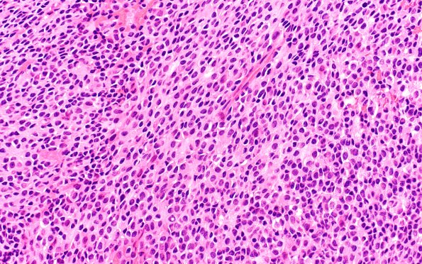 2B3 Pineal Anlage Tumor (Case 2) B2 H&E 40X