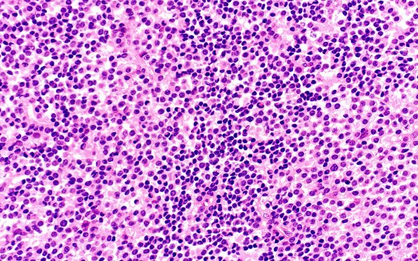 2B4 Pineal Anlage Tumor (Case 2) B3 H&E 40X