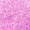 2B5 Pineal Anlage Tumor (Case 2) B2 H&E 20X