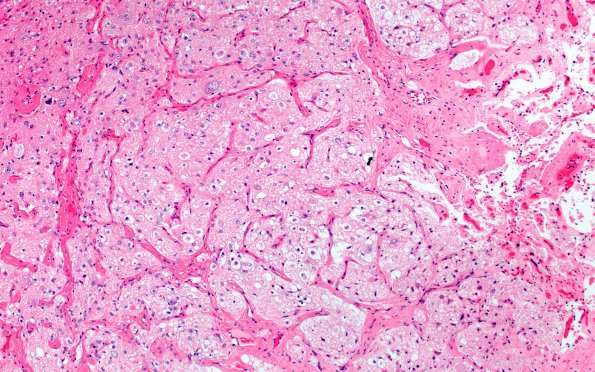 2B6 Pineal Anlage Tumor (Case 2) B6 H&E 10X