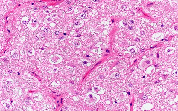 2B7 Pineal Anlage Tumor (Case 2) B6 H&E 40X