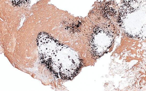 2C1 Pineal Anlage Tumor (Case 2) B5 SYN 4X