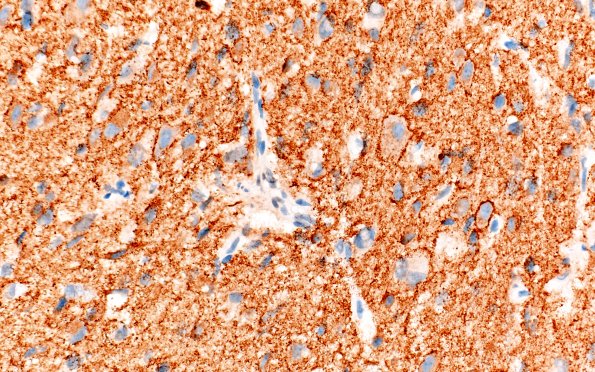 2C2 Pineal Anlage Tumor (Case 2) A2 SYN 40X
