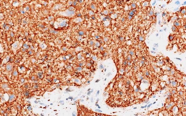 2C3 Pineal Anlage Tumor (Case 2 B5 SYN 40X