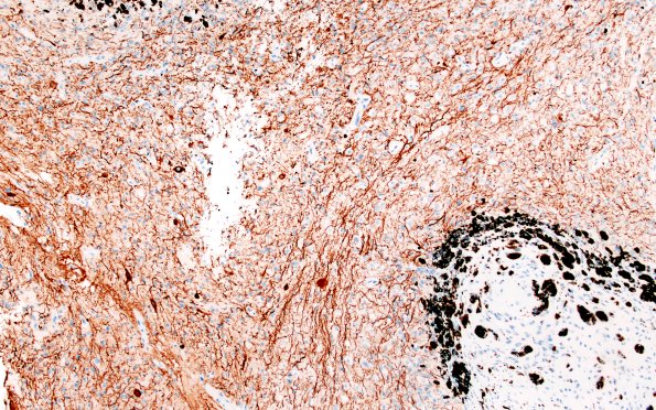 2D1 Pineal Anlage Tumor (Case 2) B5 NF 10X