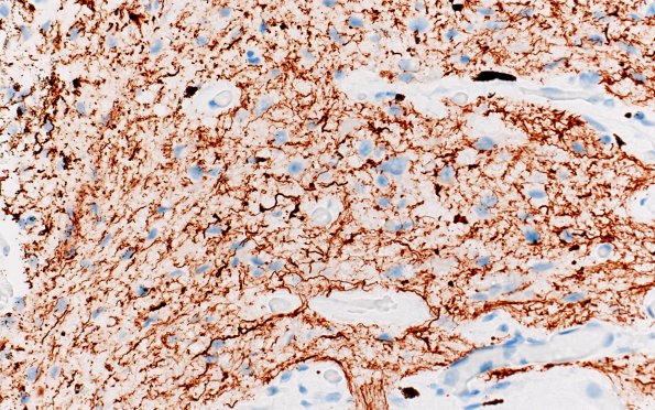2D2 Pineal Anlage Tumor (Case 2) B5 NF 40X 2