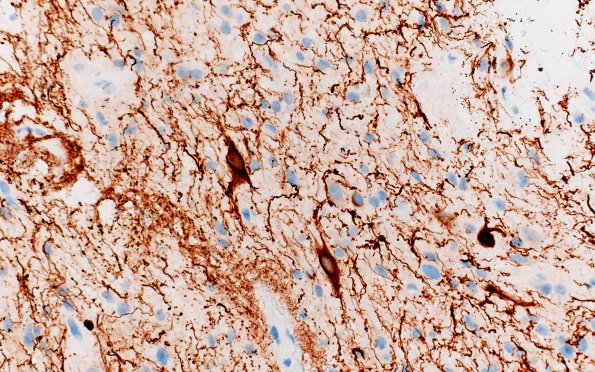 2D3 Pineal Anlage Tumor (Case 2) B5 NF 40X