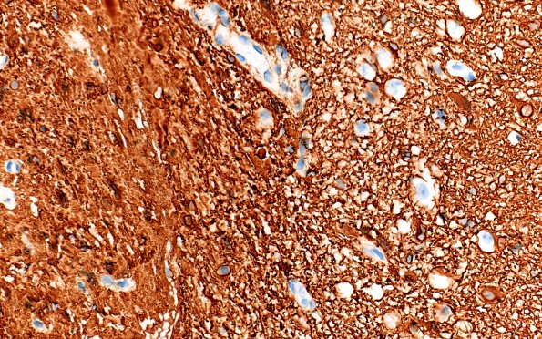 2F2 Pineal Anlage Tumor (Case 2) B5 GFAP 40X