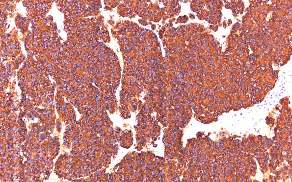 10B1 Pineoblastoma (Case 10) SYN 20X